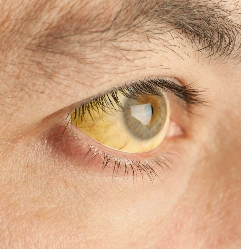 manipuleren schroef kolf Yellow eyes: Causes in newborns, children, and adults