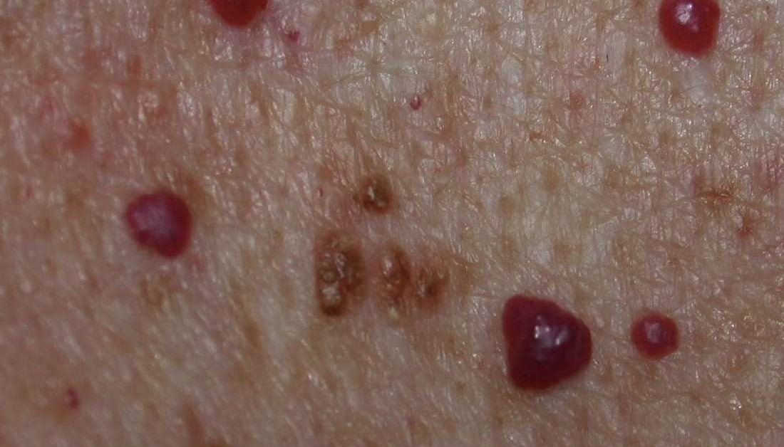 Cherry angioma: Symptoms, causes, and treatment
