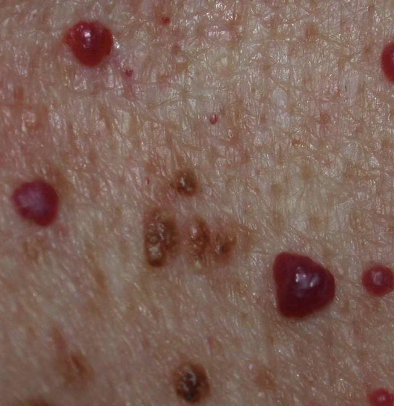 Tomat forbedre Forræderi Cherry angioma: Symptoms, causes, and treatment