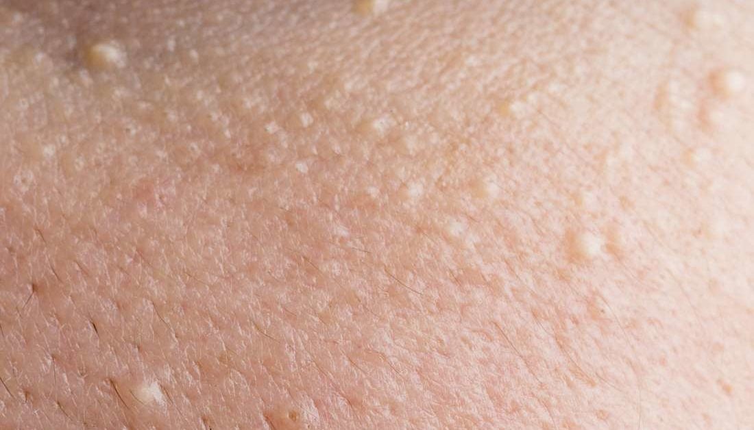 Little White Bumps On Skin Child