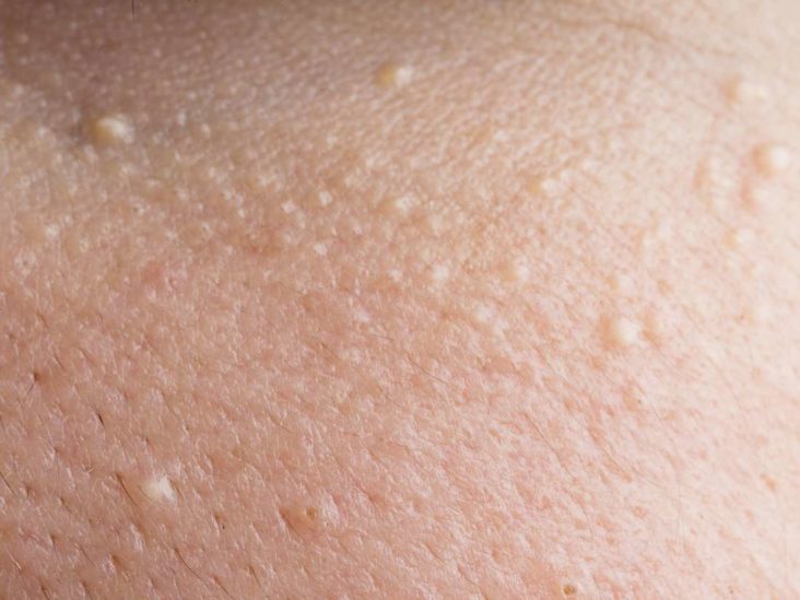 White Spots On The Skin Possible Causes And Treatments