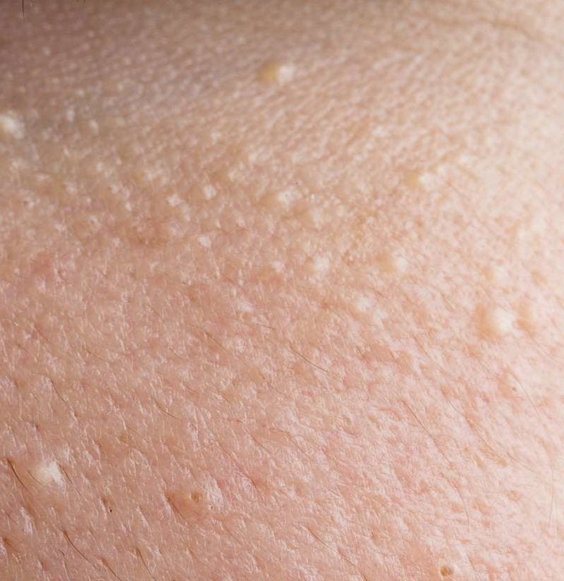 pictures of skin tags on penis under skin