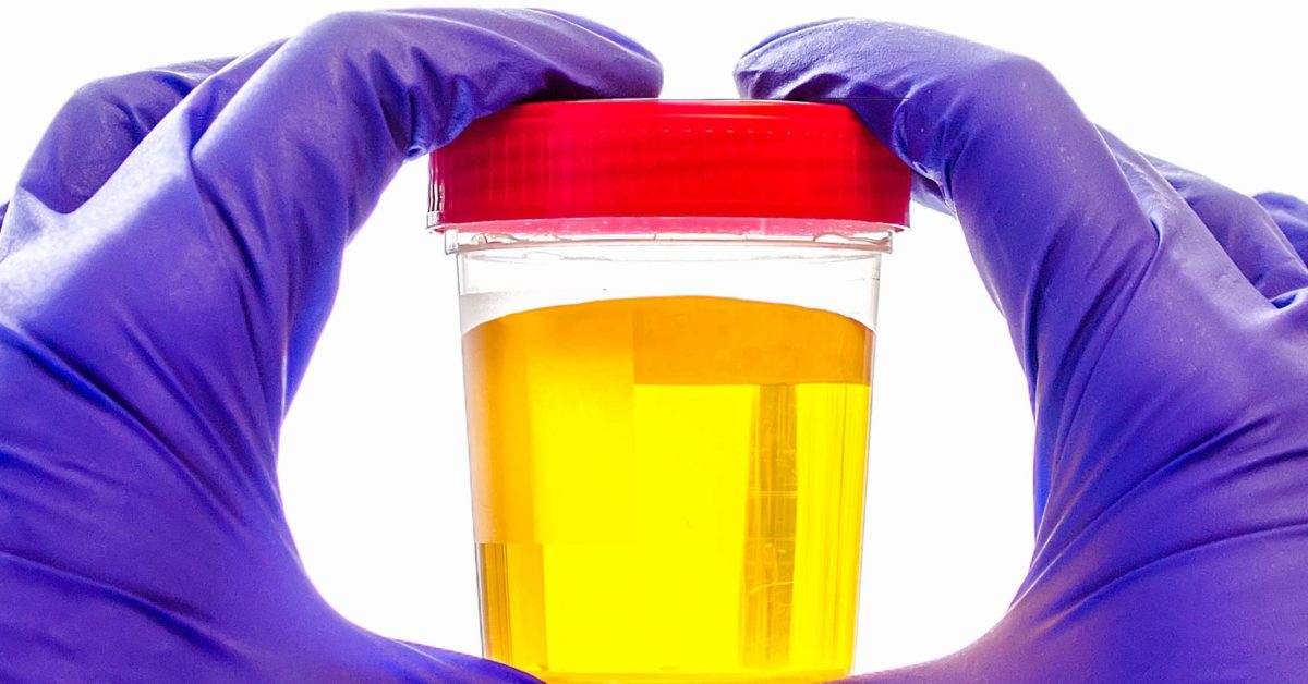 Bright yellow urine: Colors, changes, and causes