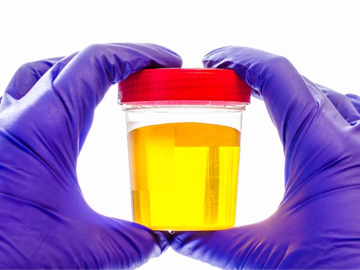 Bright yellow urine: Colors, changes, and causes