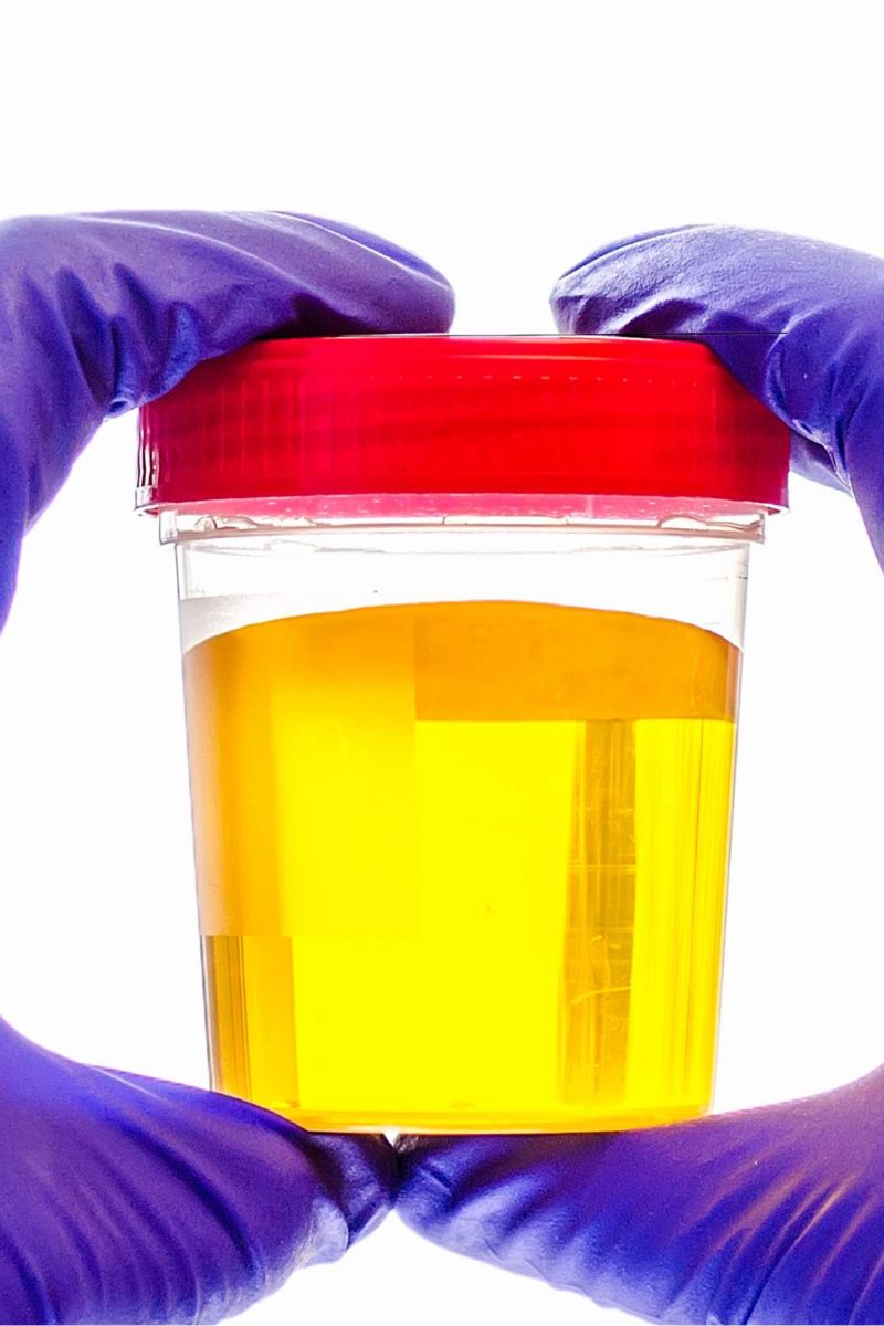 dark yellow urine symptoms