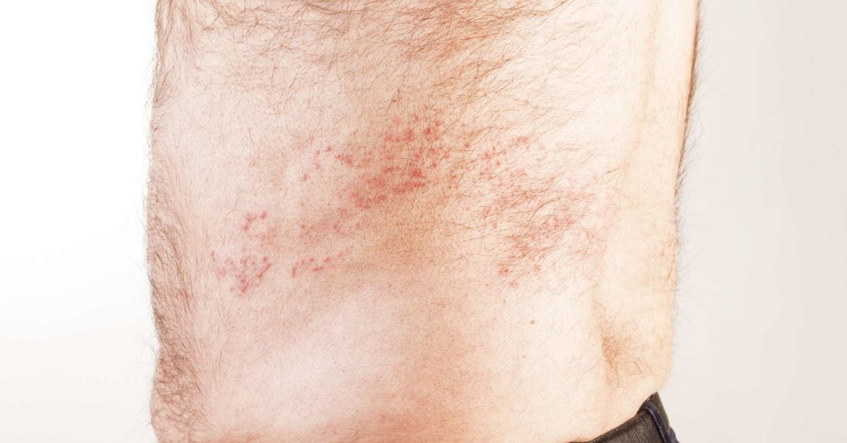 Is It Shingles Symptoms Vs Other Conditions And Causes