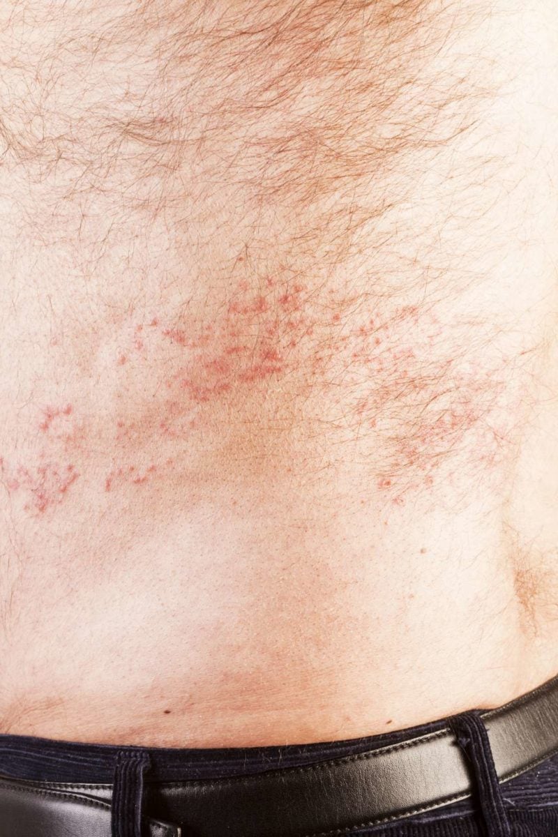 long term after effects of shingles