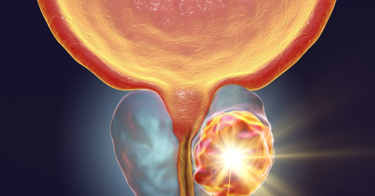 advanced-prostate-cancer-stages-risk-factors-symptoms-and-treatment