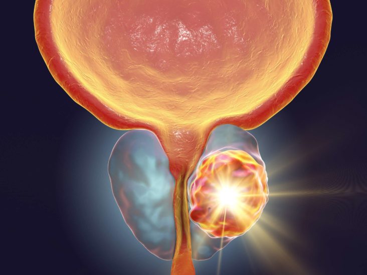 Screening For Prostatic Cancer: New Guidelines