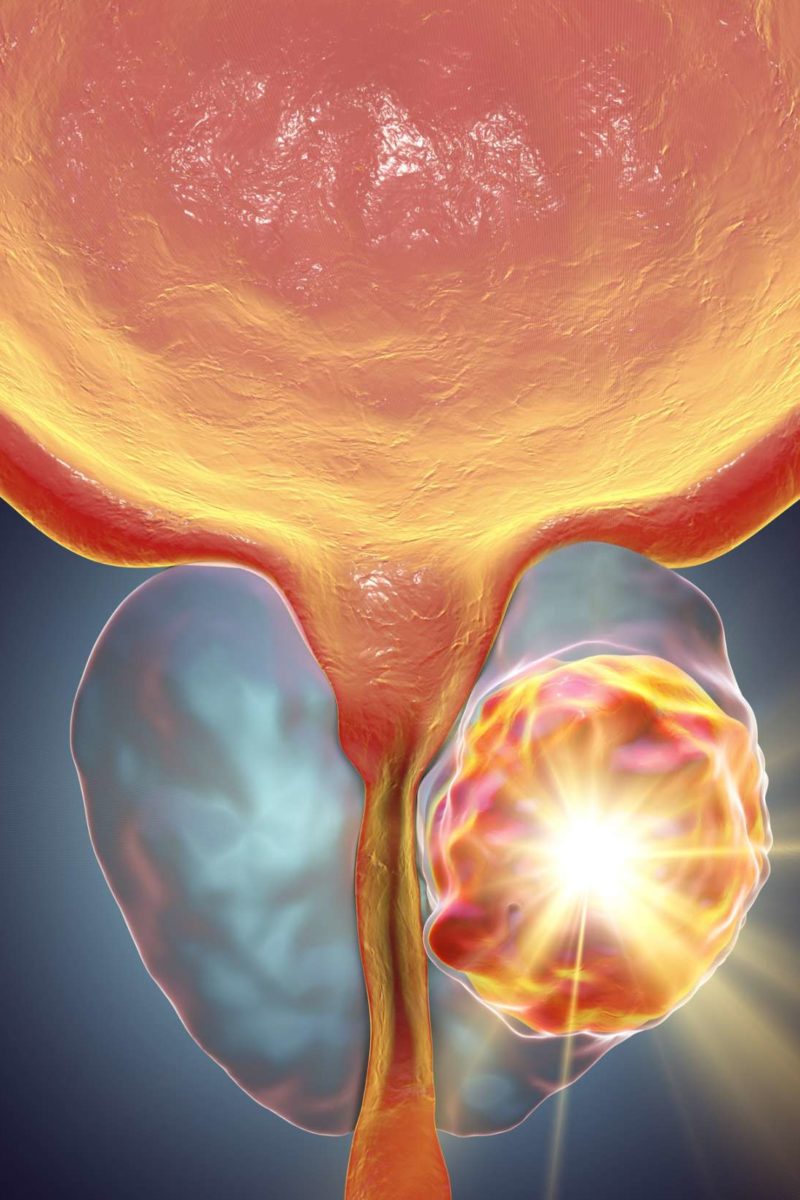 aggressive prostate cancer Prostatis hogyan lehet javítani a vizeletet