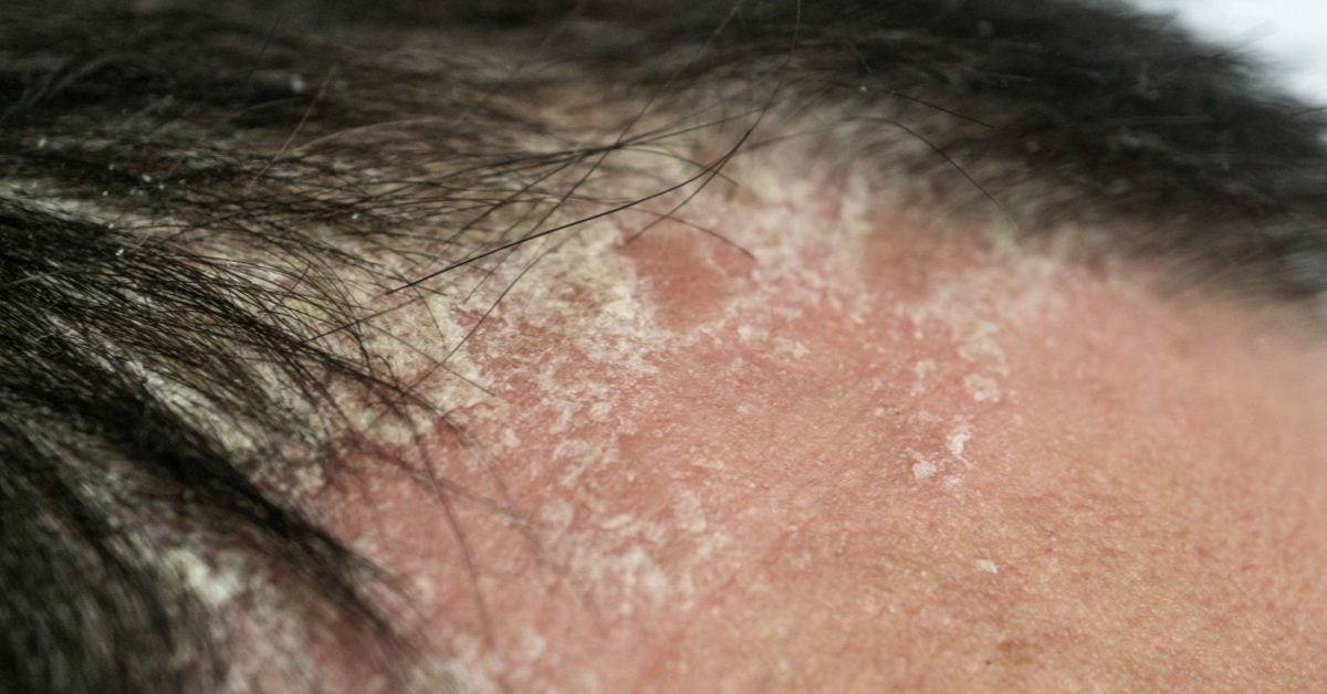 psoriasis flakes in hair