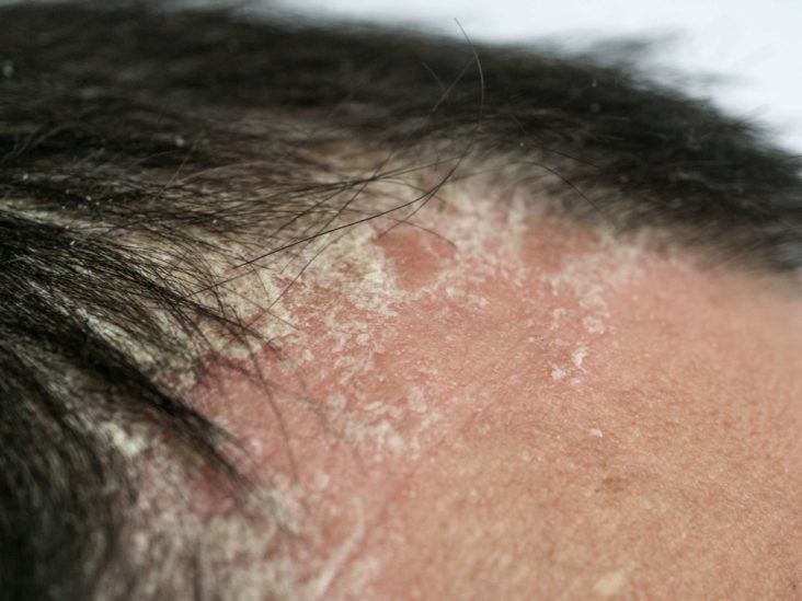psoriasis causing itchy scalp)