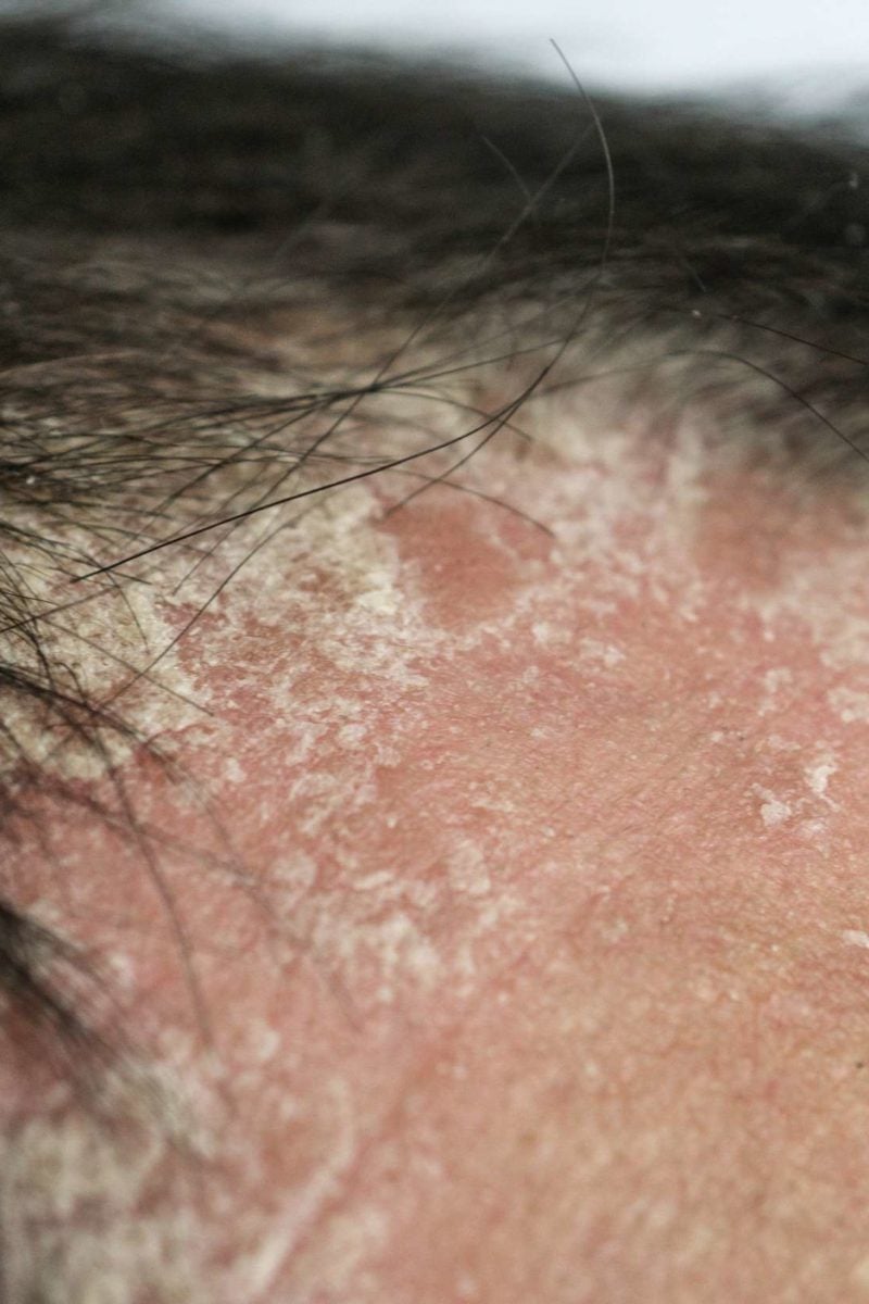 Can Hair Loss Due To Psoriasis Grow Back