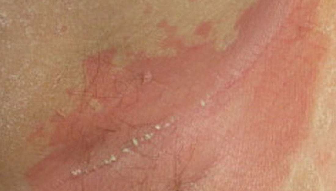Psoriasis flexor felületek és a bőr ráncok vagy inverz psoriasis