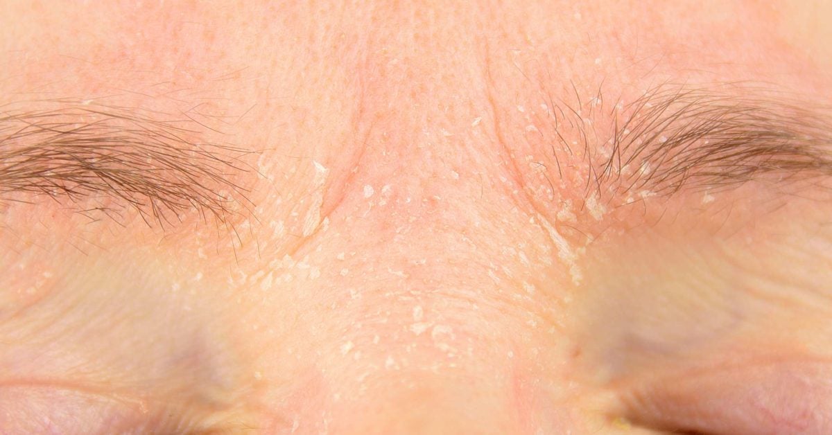 psoriasis on the face symptoms causes and treatments pikkelysömör kezelés lemez