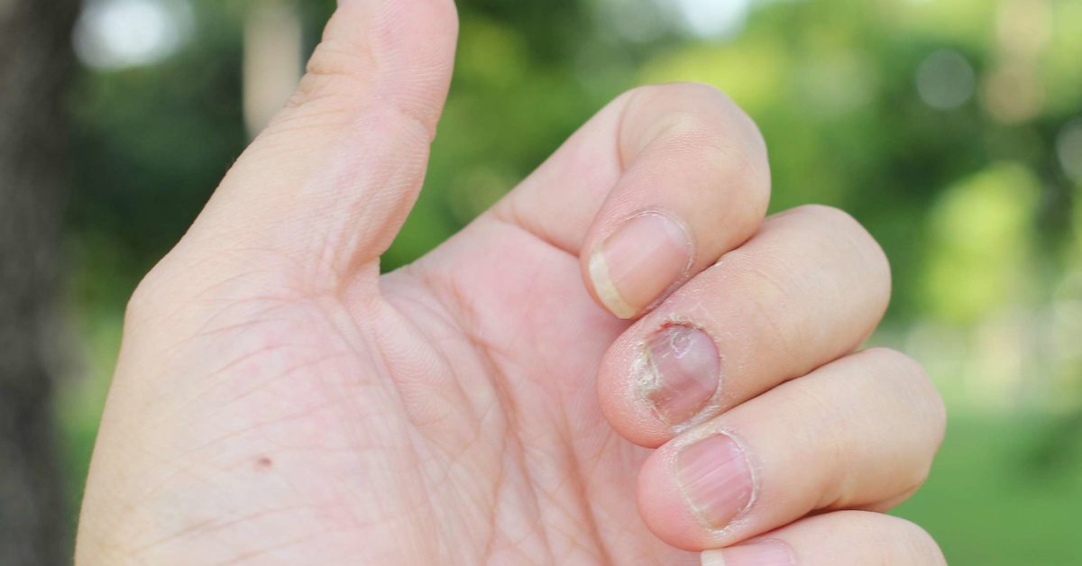 nail psoriasis causes and treatment