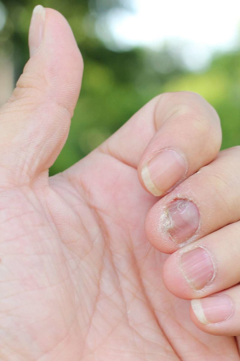 Cómo tratar los hongos en las uñas de los niños  Eres Mamá