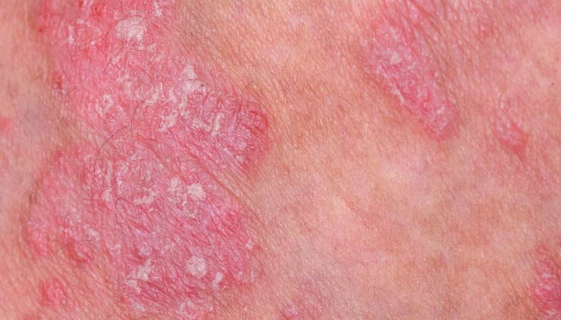 psoriasis protein deficiency