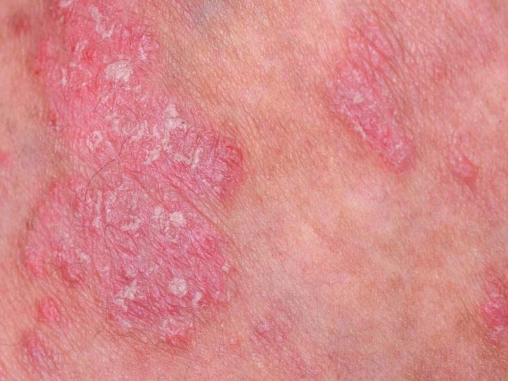psoriasis crohns flare