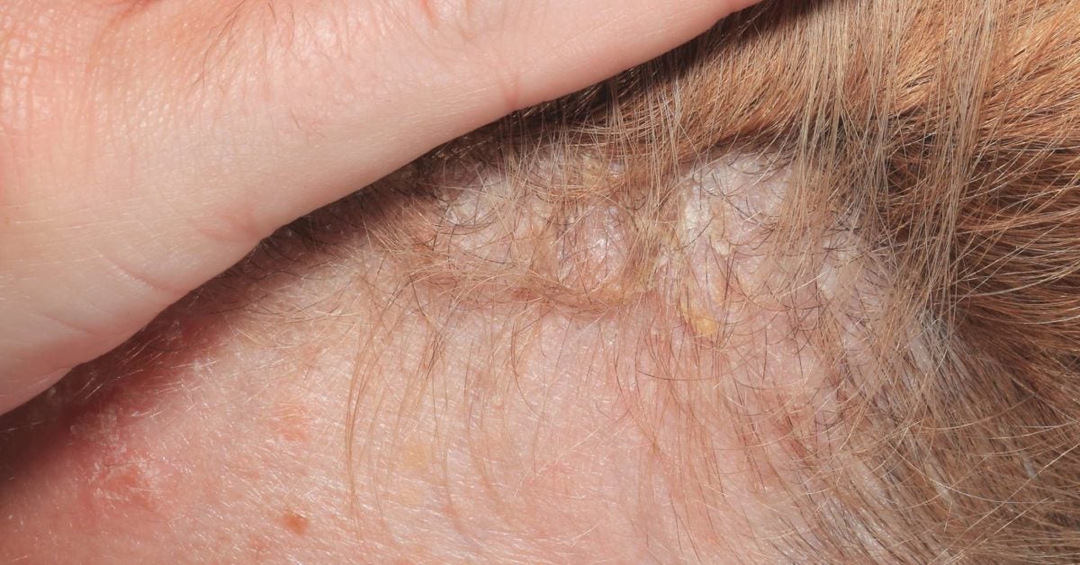 plaque psoriasis symptoms scalp