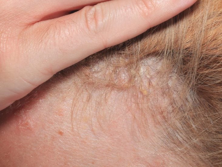 bleeding scalp psoriasis treatment psoriasis removal scalp