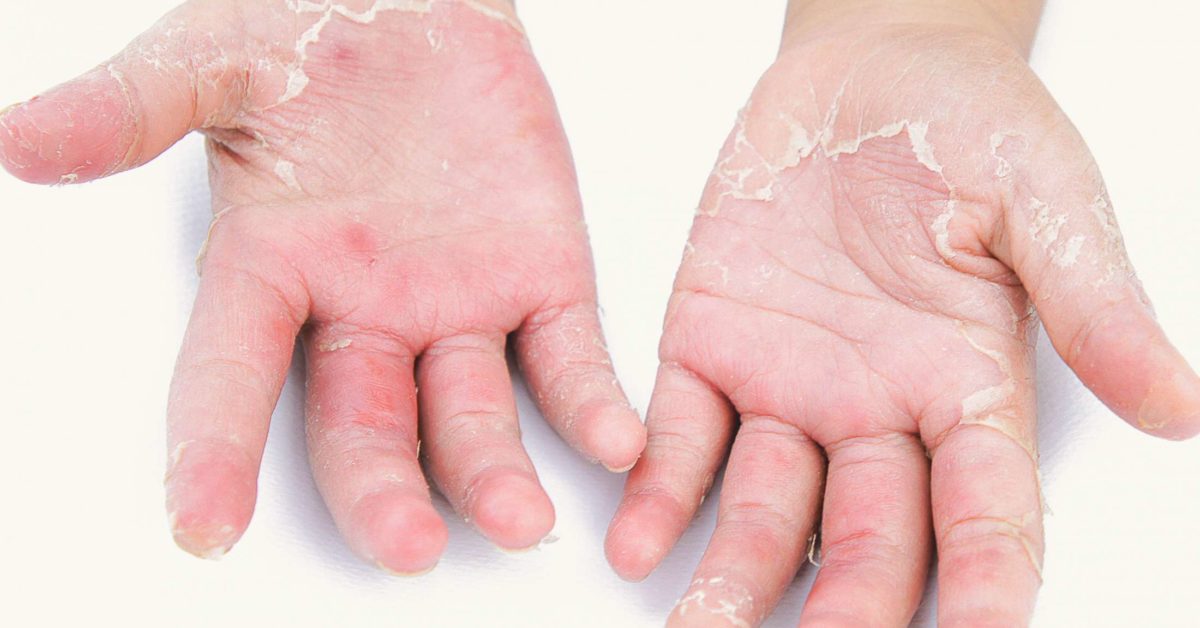 psoriasis arthritis labor)