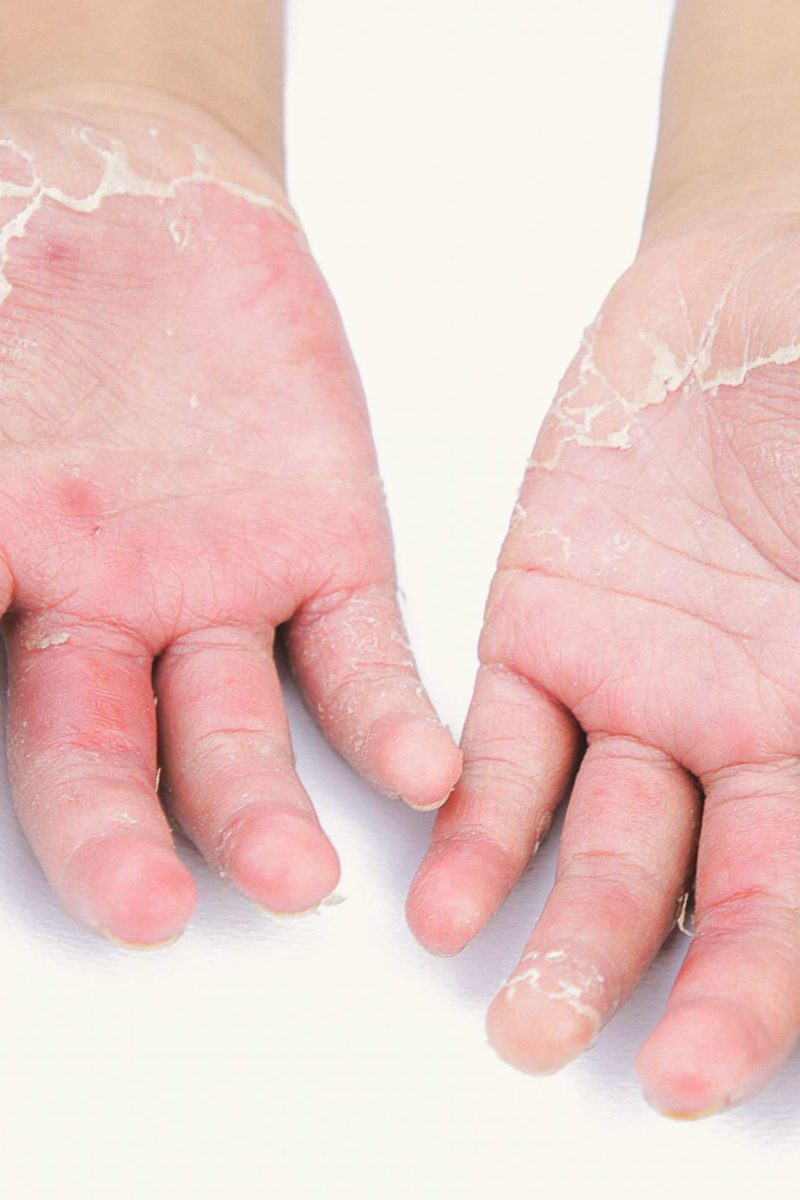 pustular psoriasis hands treatment)