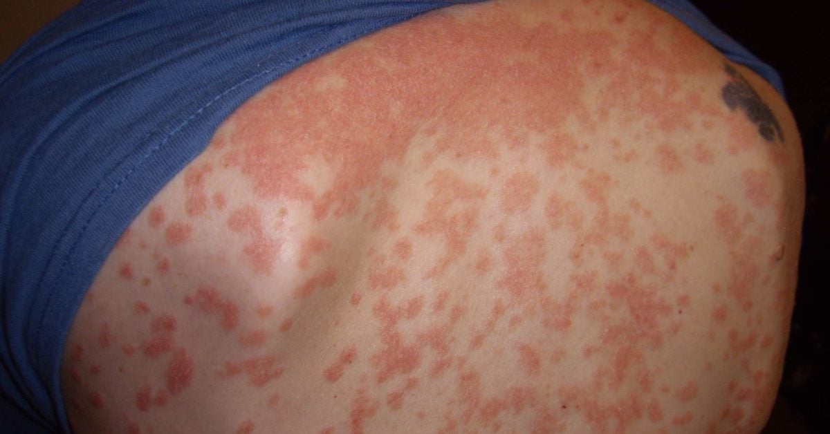 is psoriasis an autoimmune disease nhs)