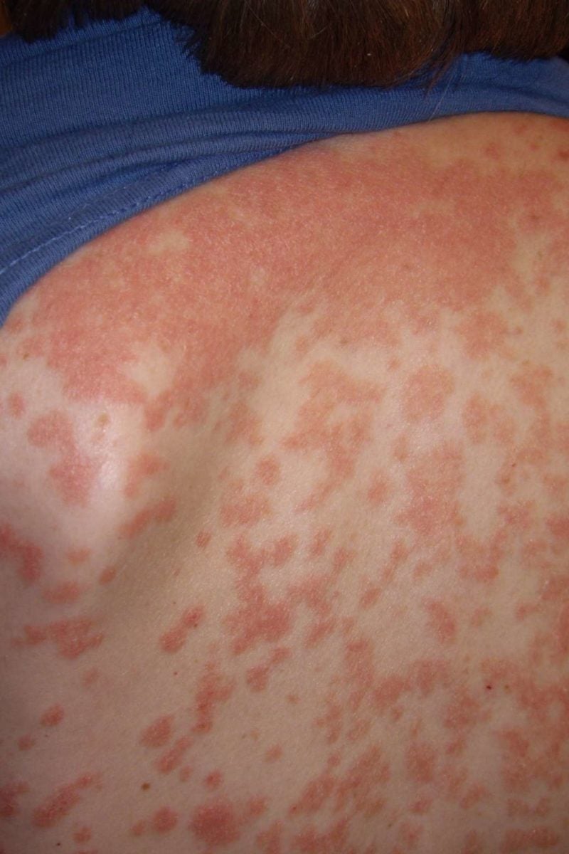 early signs and symptoms of guttate psoriasis