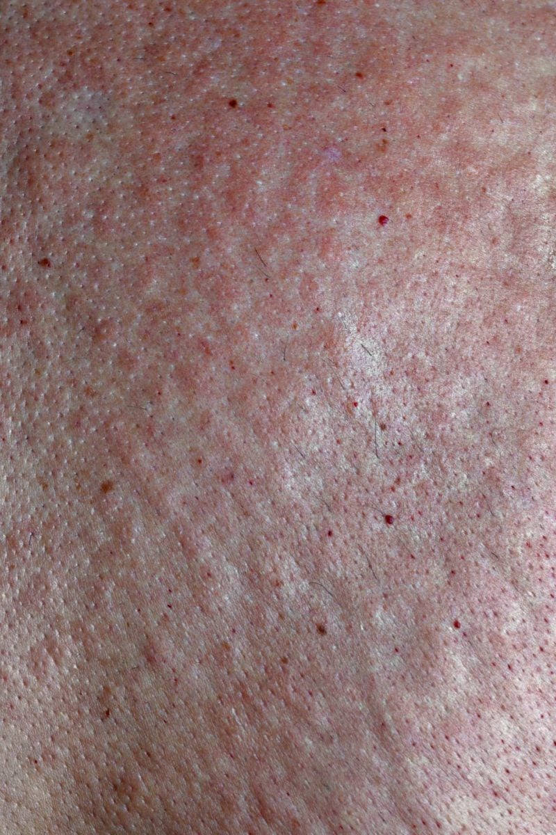 Herpetiform impetigo pikkelysömör