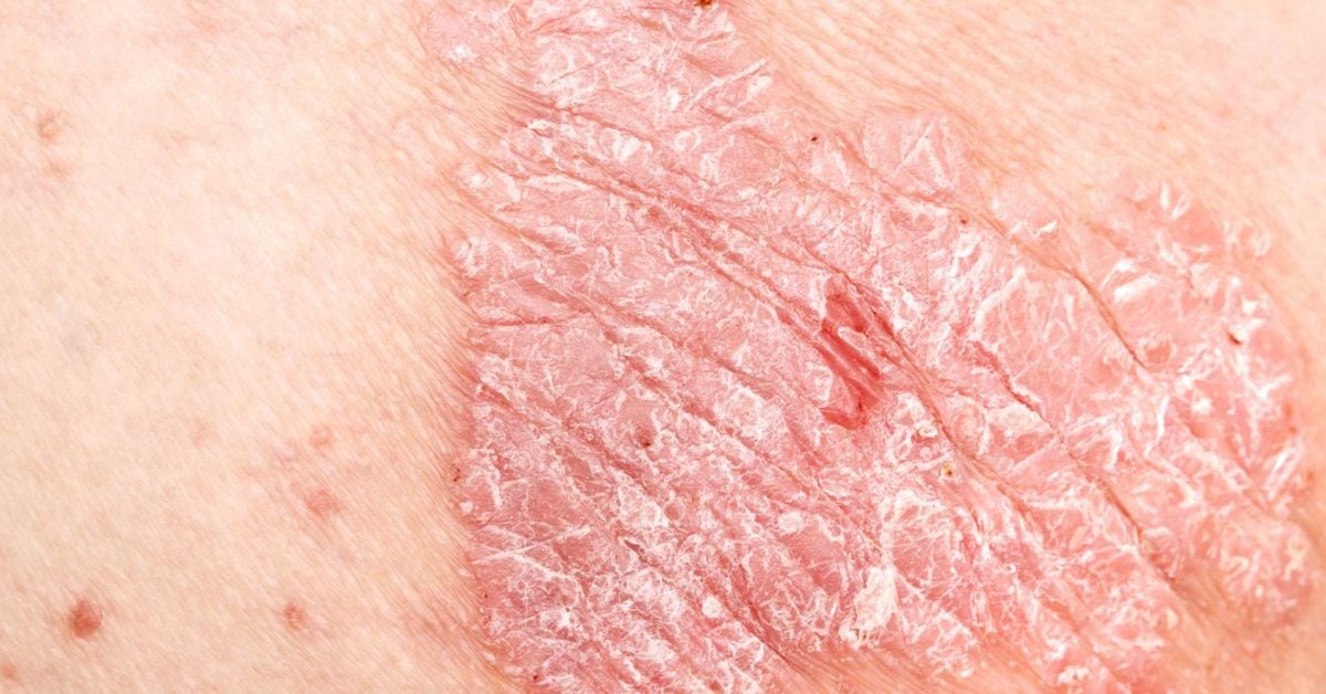 does psoriasis burn)