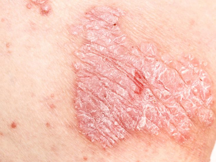 psoriasis nhs)