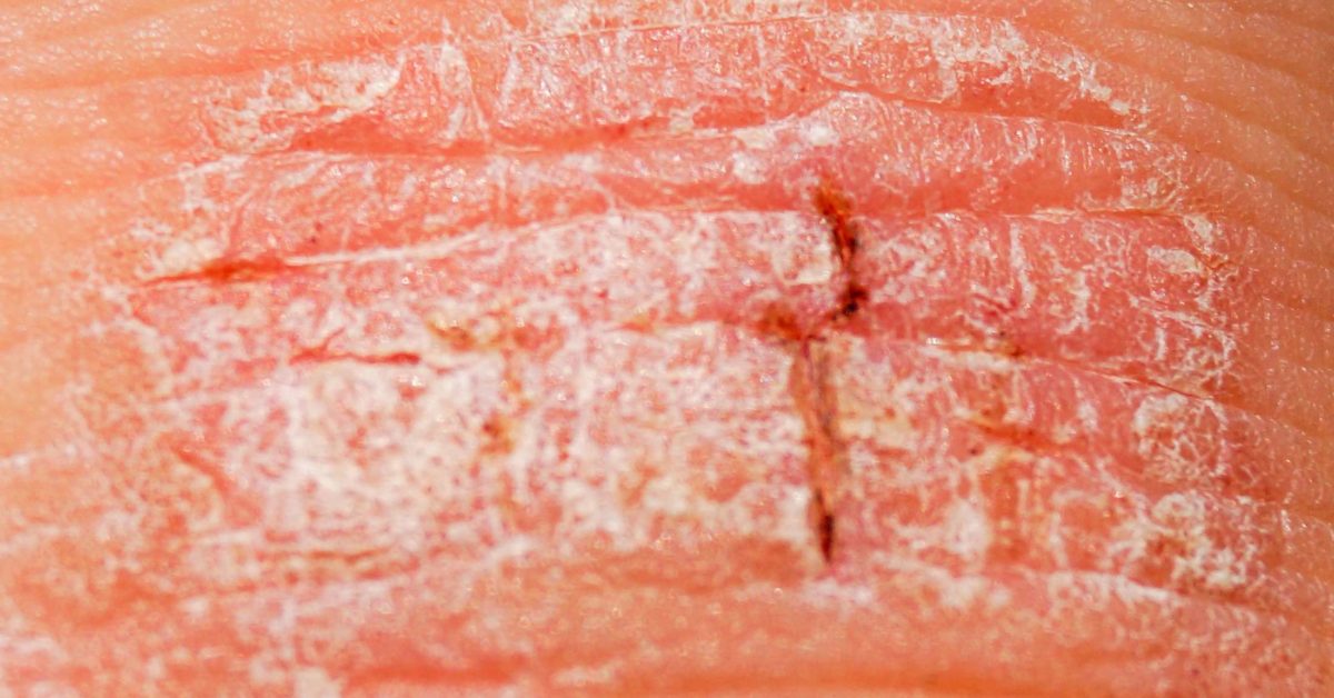 Psoriasis signs 