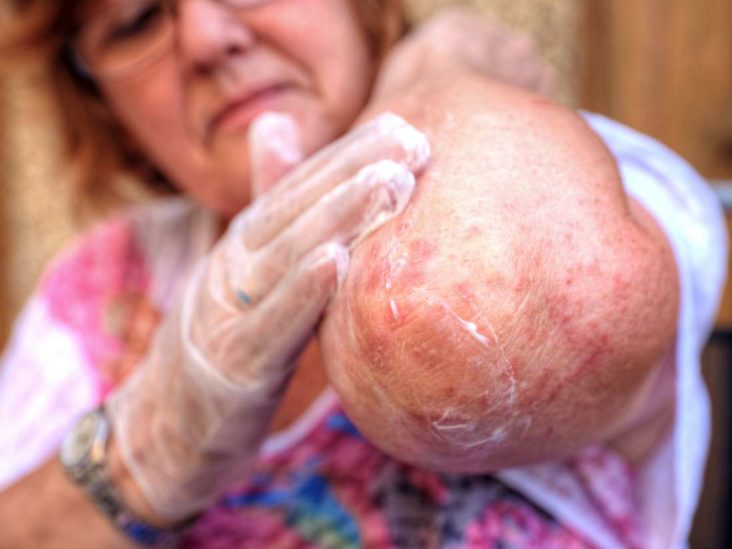 salicylic acid eczema