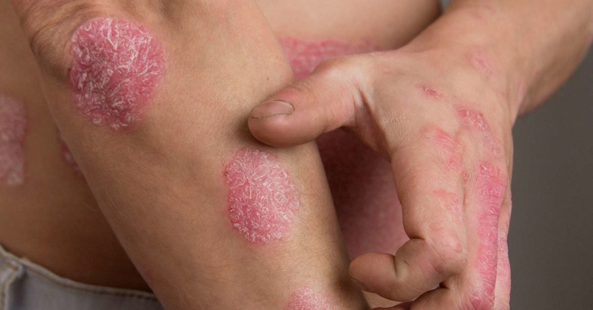 Psoriasis tünetei hindi nyelven