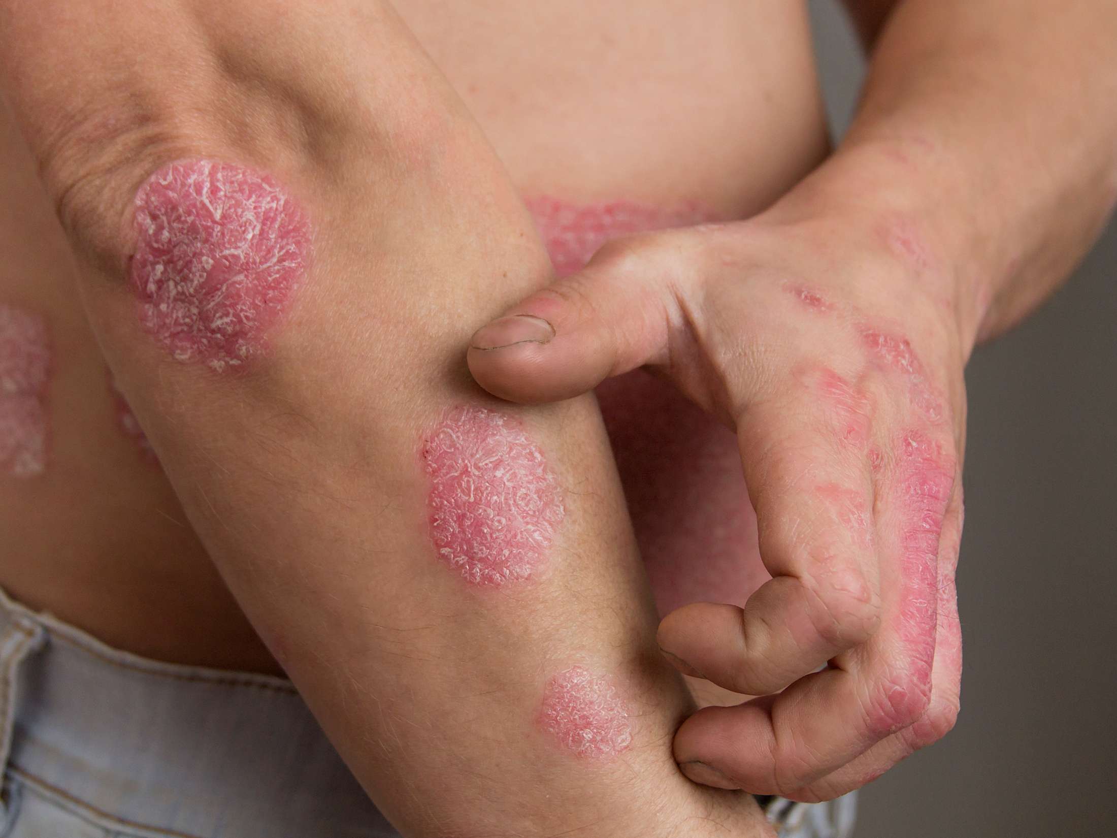 does psoriasis burn and itch