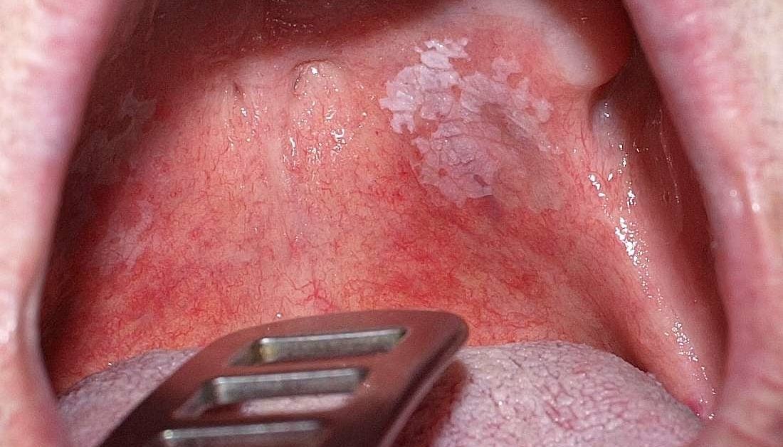 Leukoplakia Symptoms Causes And Prevention