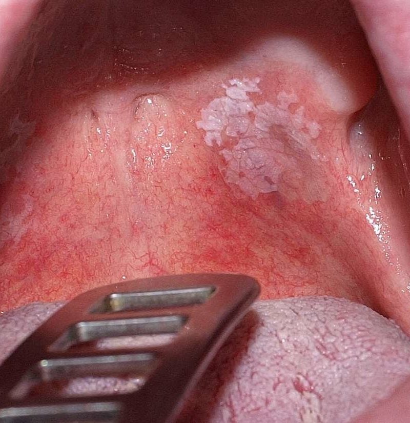 trigone leukoplakia