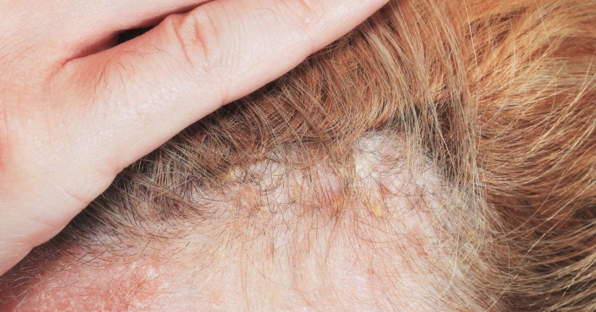 Dermatitis seborreica: remedios caseros que ayudan a aliviar los