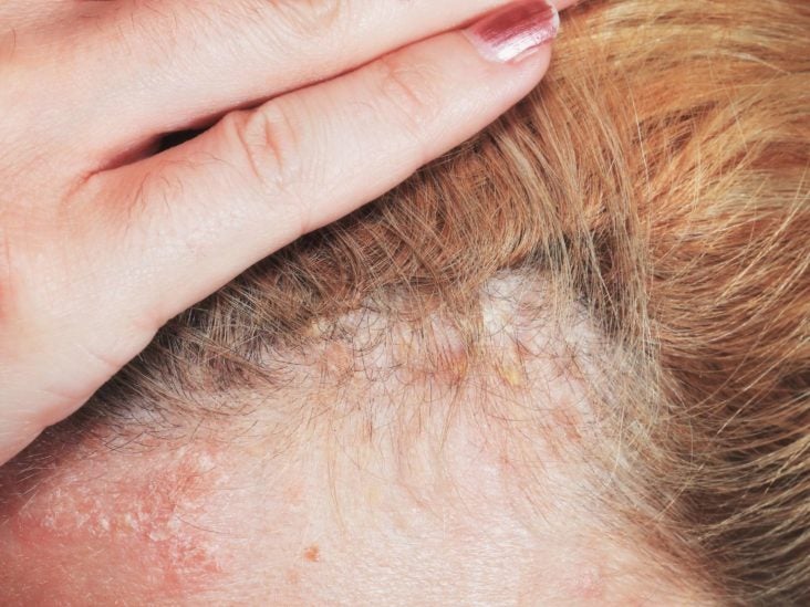 Tratamiento de psoriasis en el cuero cabelludo: PSORISDIN