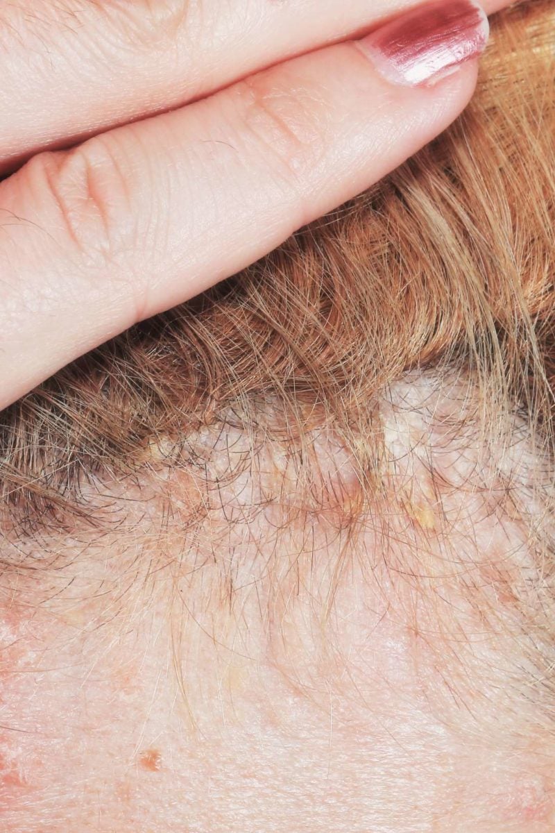 how to cure psoriasis permanently on head