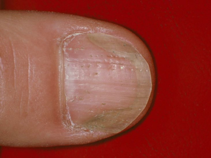 Dents in fingernails tiny Ridges in