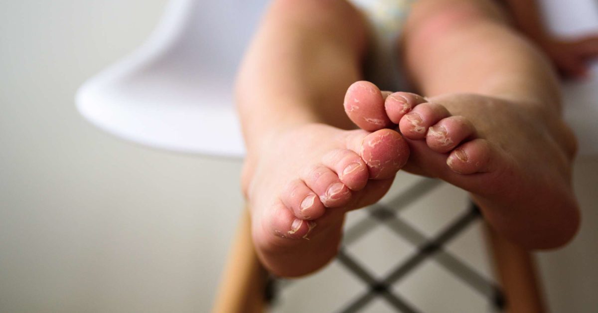 Psoriasis in children Symptoms, treatments, and causes