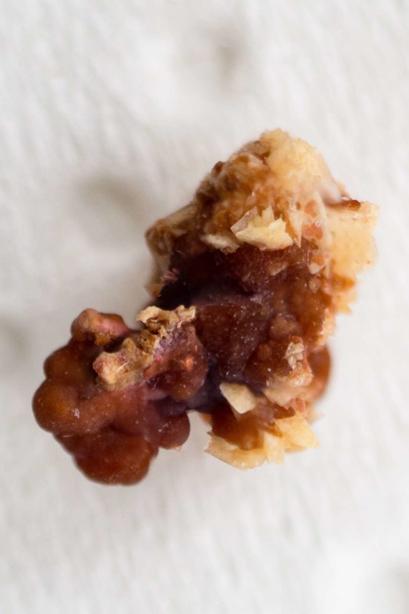 Warm, wet weather The key to kidney stones?