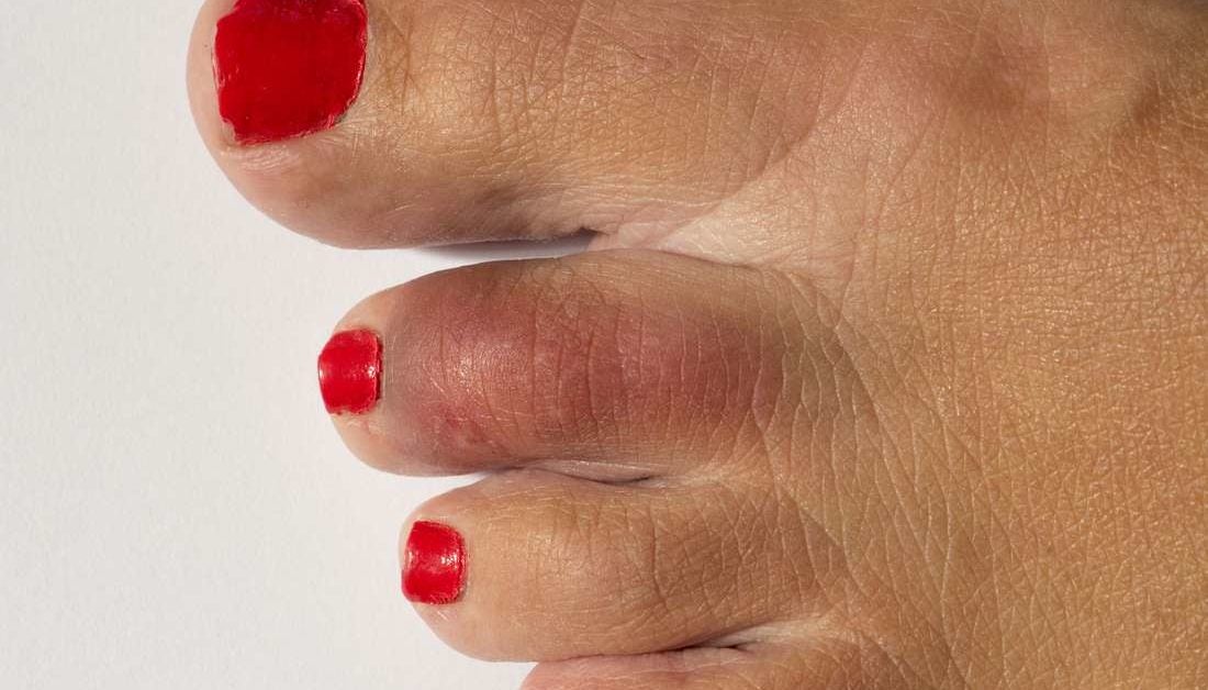 broken-toe-treatments-symptoms-pictures-and-healing-time