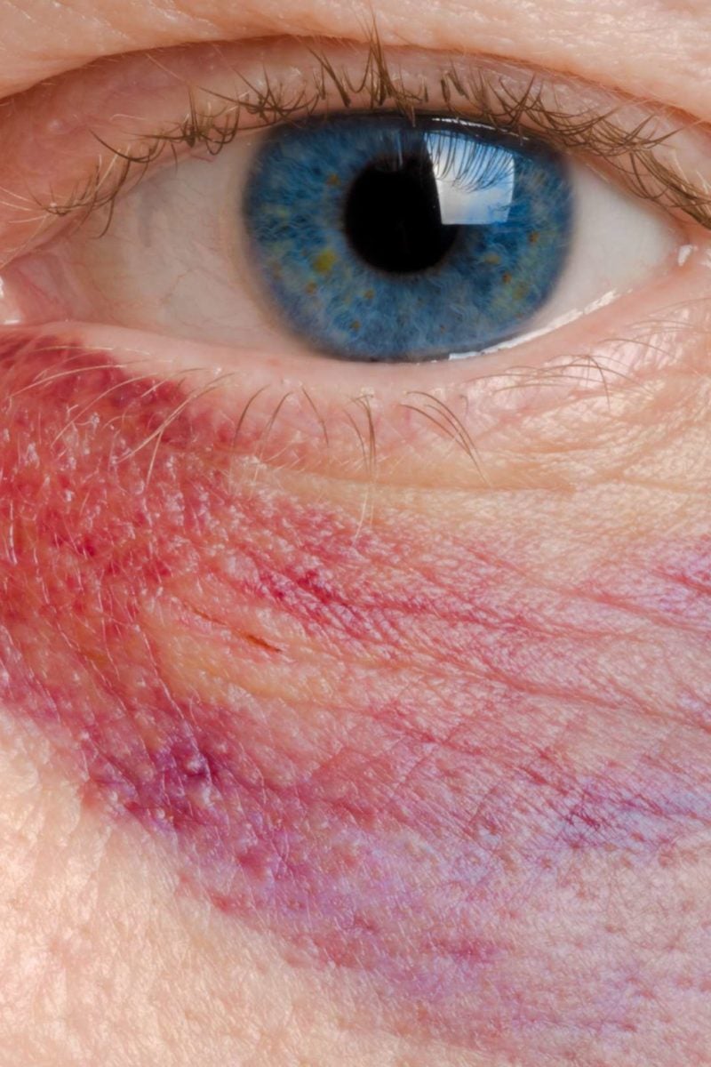 Blue Tinge Under Eyes Gertybudget