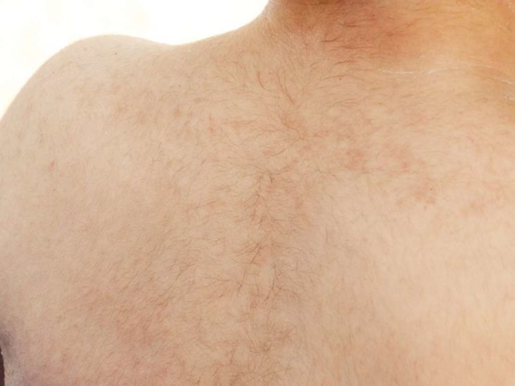 What To Know About Facial Laser Hair Removal For Both Men And Women