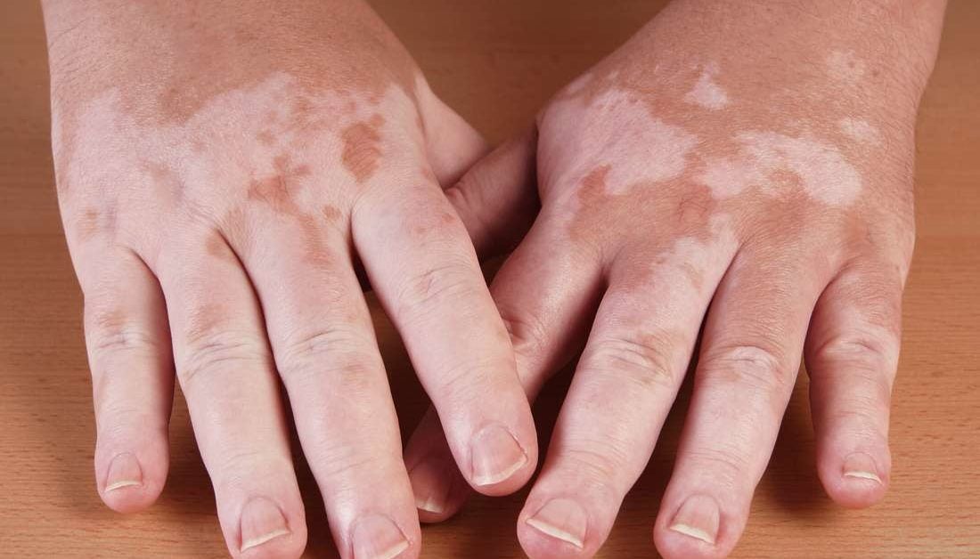 hypopigmentation-causes-types-and-treatment