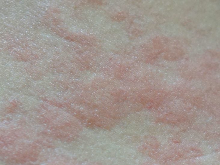 Effective Ways To Get Rid Of Hives