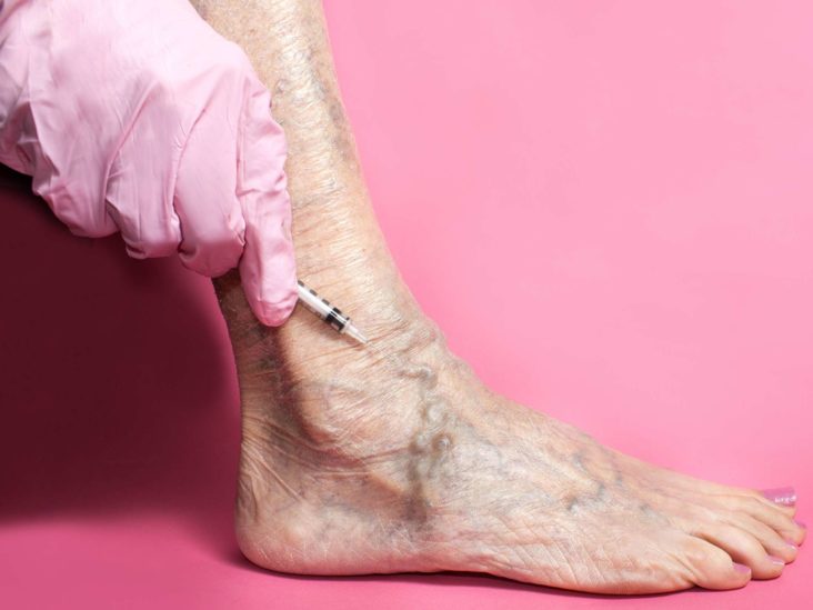 Sclerotherapy: Uses, side effects, and recovery